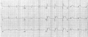 12LeadECGAcuteAnteriorMyocardialInfarction-figure15a