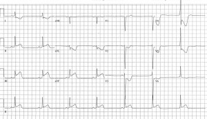 12 Lead ECG Acute Inferior Myocardial Infarction figure 15a